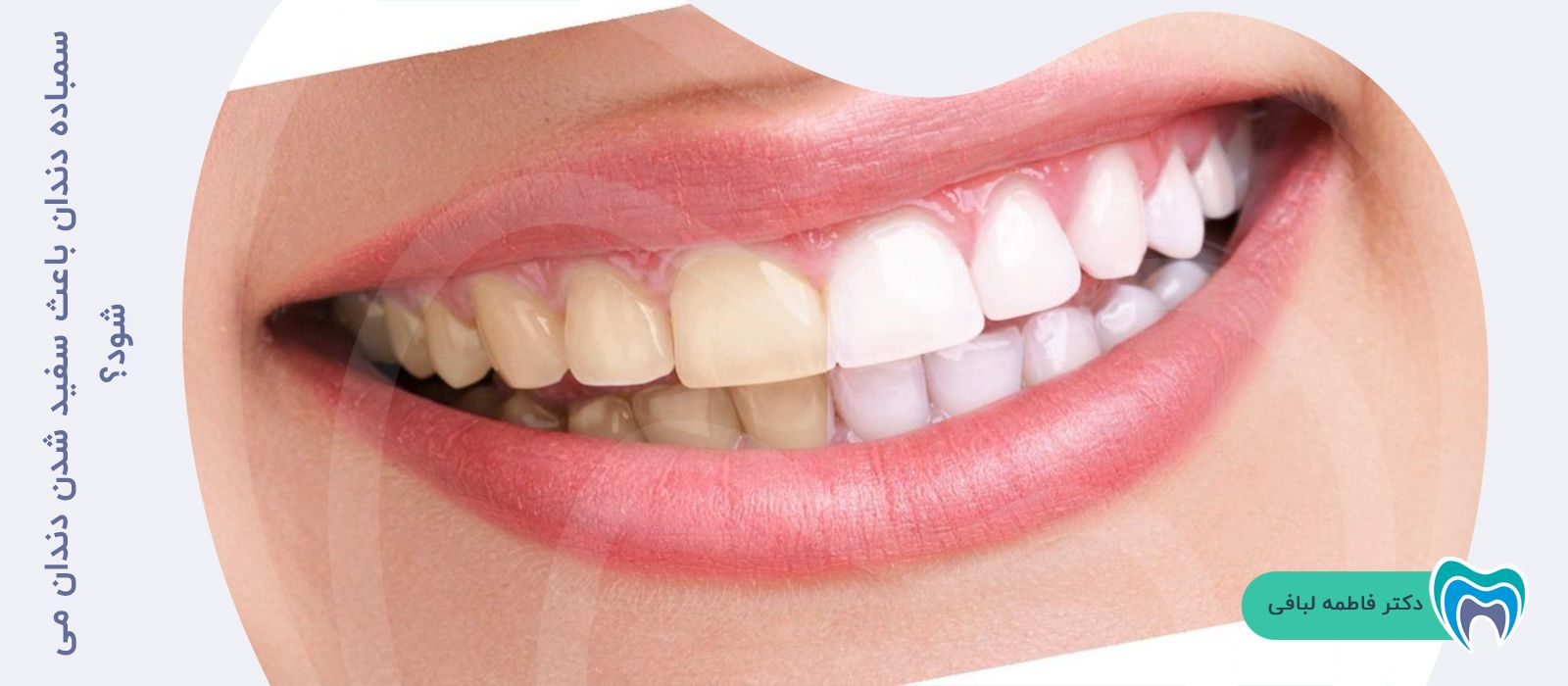 آیا سمباده دندان باعث سفید شدن دندان می‌شود؟