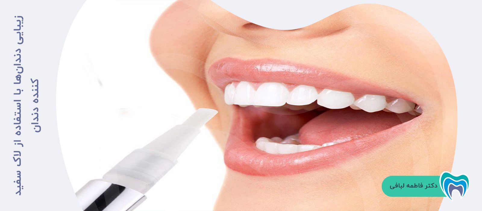 زیبایی دندان‌ها با استفاده از لاک سفید کننده دندان