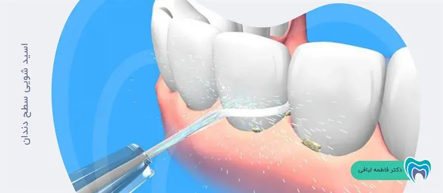 منظور از اسید شویی سطح دندان برای کامپوزیت چیست؟