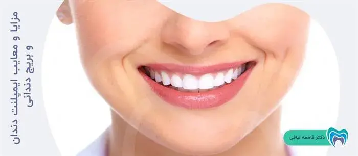 مزایا و معایب ایمپلنت دندان و بریج دندانی