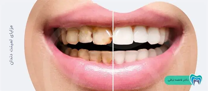 لمینت دندان چه مزایایی دارد؟