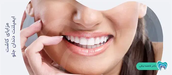 مزایای کاشت ایمپلنت دندان جلو