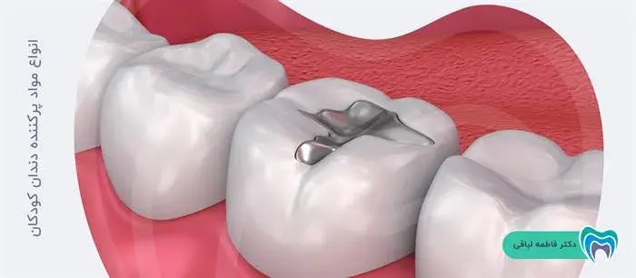 انواع مواد پرکننده دندان کودکان