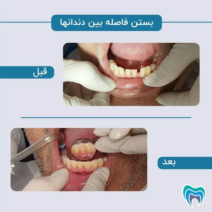 قبل و بعد از بستن فاصله بین دندان‌ها
