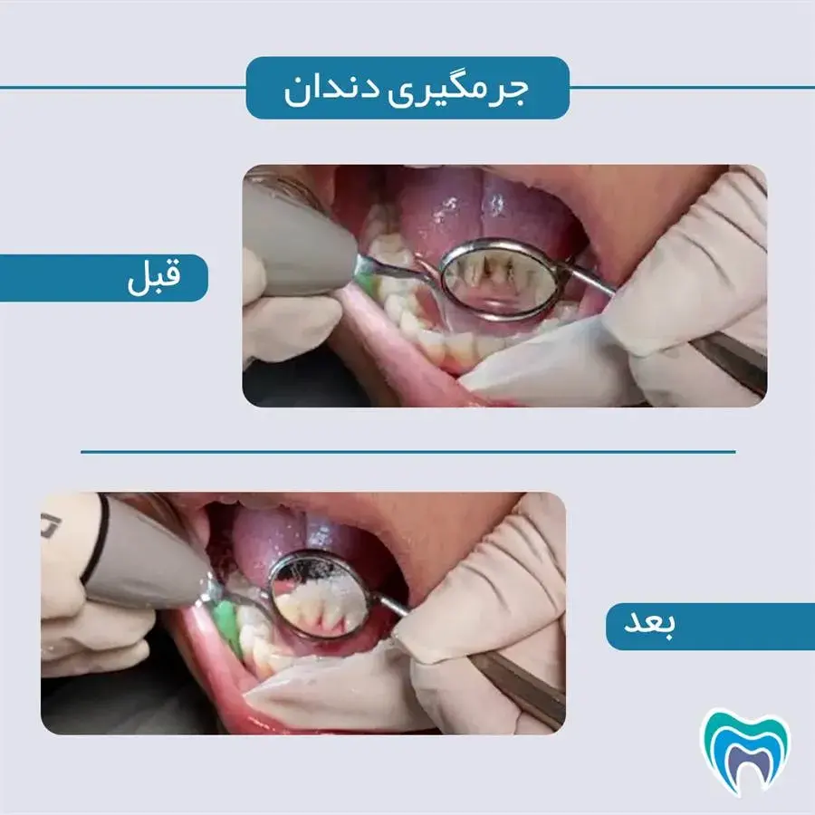 قبل و بعد درمان جرم گیری دندان