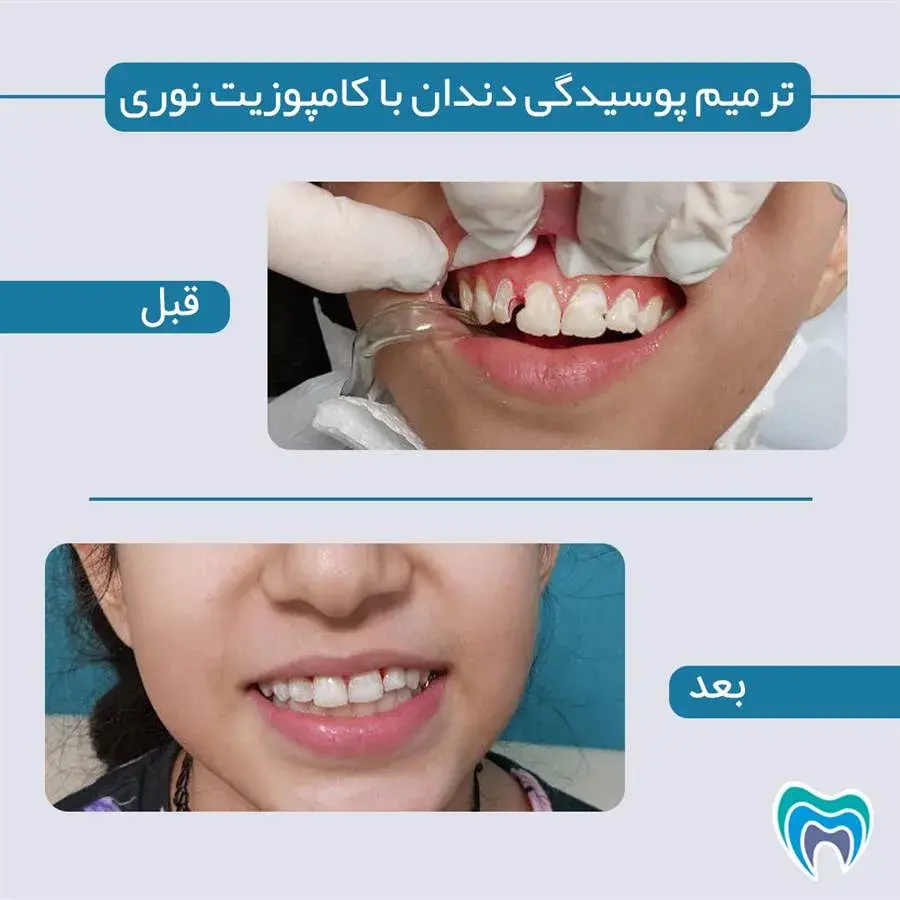 قبل و بعد از پر کردن دندان
