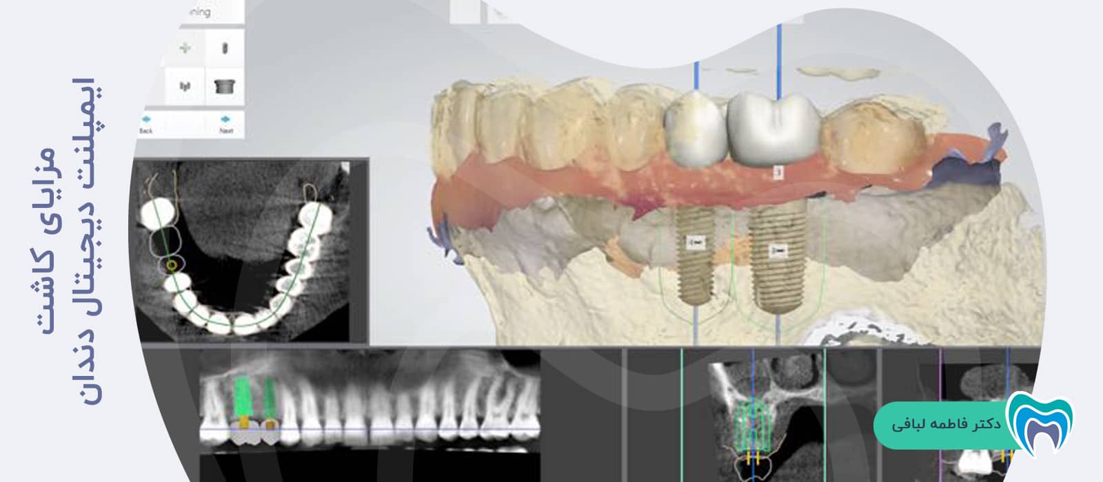 مزایای کاشت ایمپلنت دیجیتال دندان