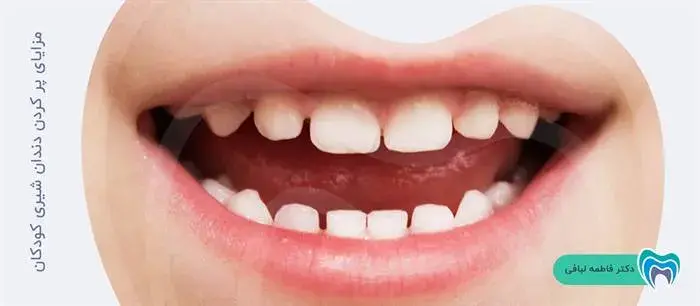 مزایای پر کردن دندان شیری کودکان