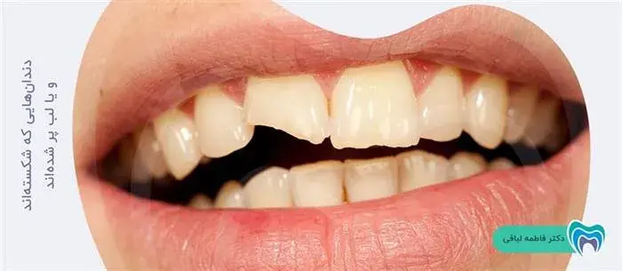 آیا لمینت برای دندانهای شکسته مناسب است؟