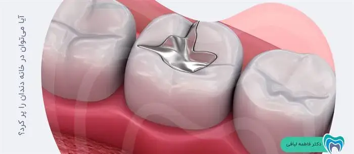آیا پر کردن دندان در خانه امکان‌پذیر است؟