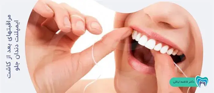 مراقبتهای بعد از کاشت ایمپلنت دندان جلو