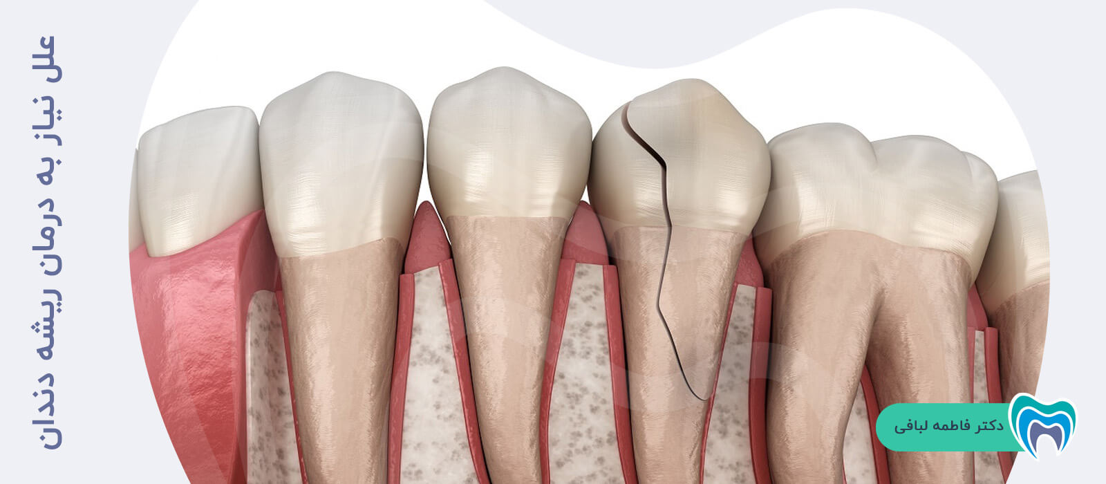 علل نیاز به درمان ریشه دندان