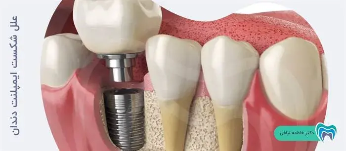 علل شکست ایمپلنت دندان