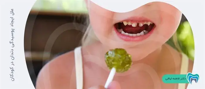 علل ایجاد پوسیدگی دندان در کودکان
