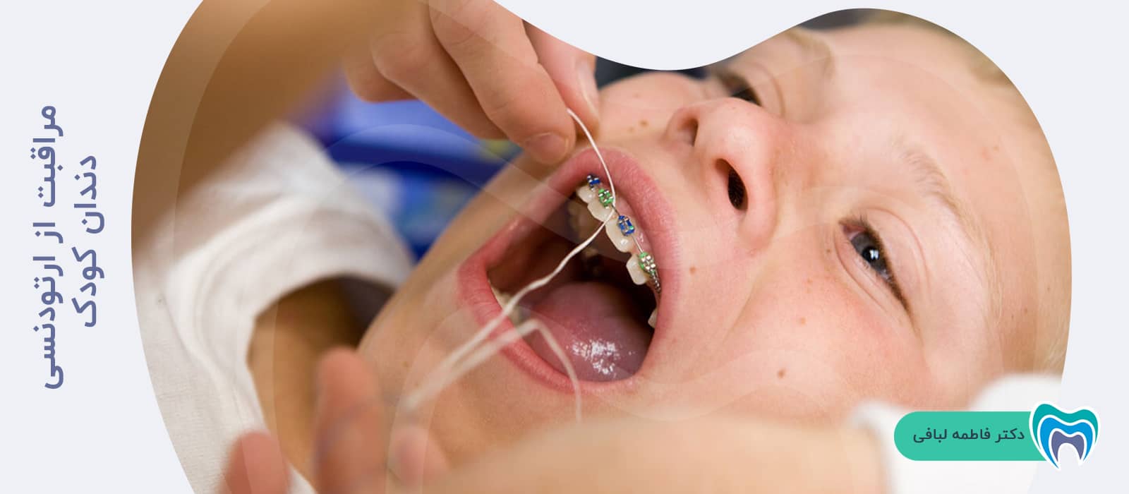 مراقبت از ارتودنسی دندان کودک