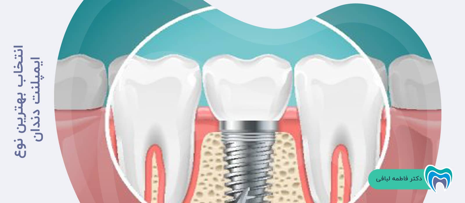 انتخاب بهترین نوع ایمپلنت دندان