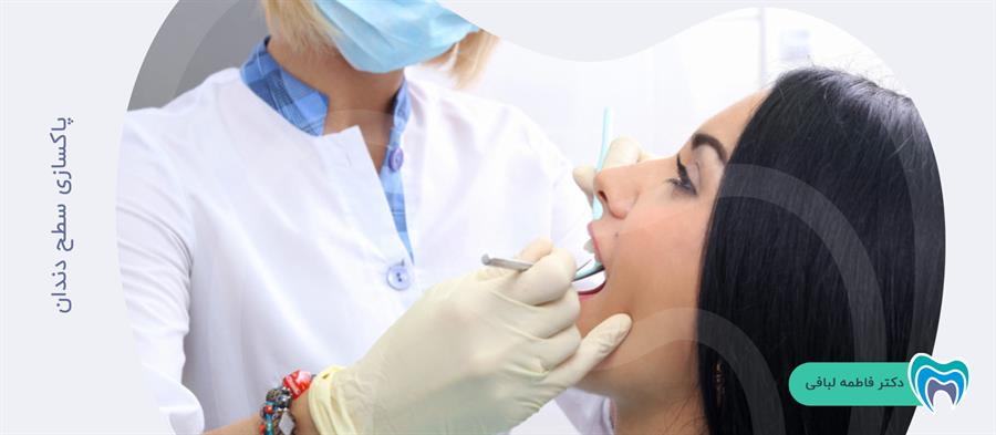 پاکسازی سطح دندان برای بلیچپینگ دندان در مطب