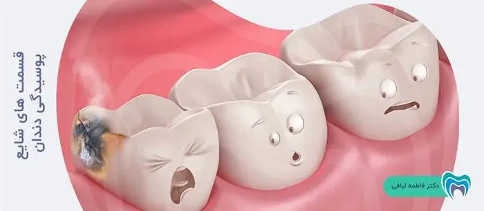 قسمت های شایع پوسیدگی دندان