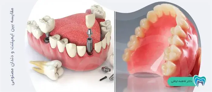 تفاوت بین ایمپلنت و دندان مصنوعی