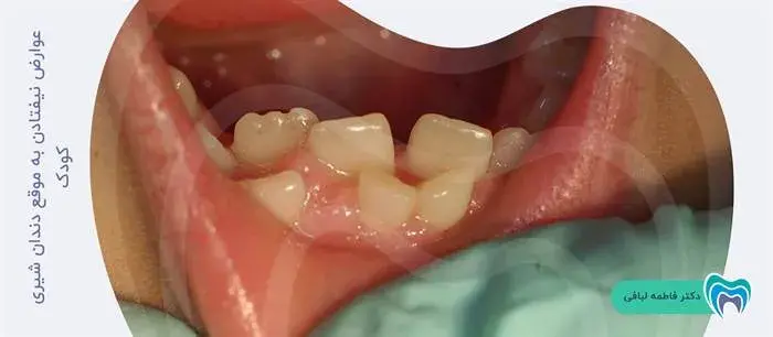 عوارض نیفتادن به موقع دندان شیری کودک