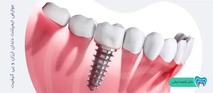 عوارض ایمپلنت دندان ارزان و بی کیفیت