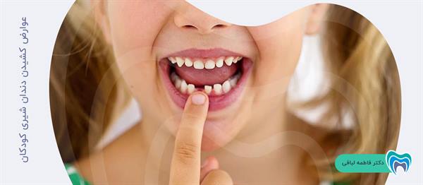 عوارض کشیدن دندان شیری کودکان