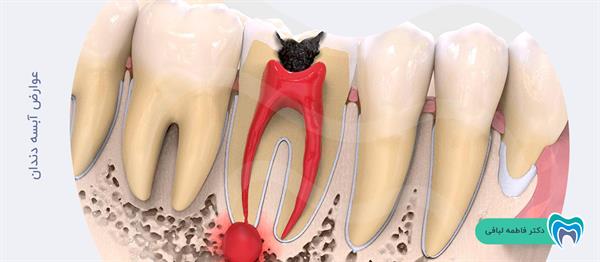 عوارض آبسه دندان