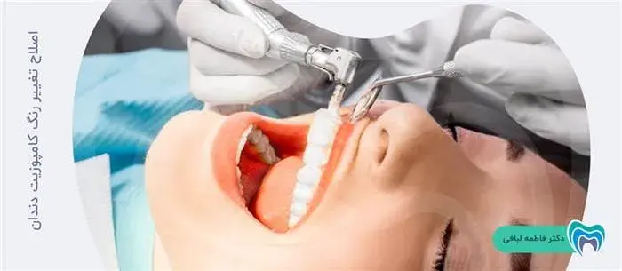 درمان تغییر رنگ کامپوزیت دندان