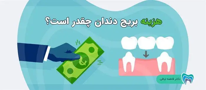 هزینه بریج دندان