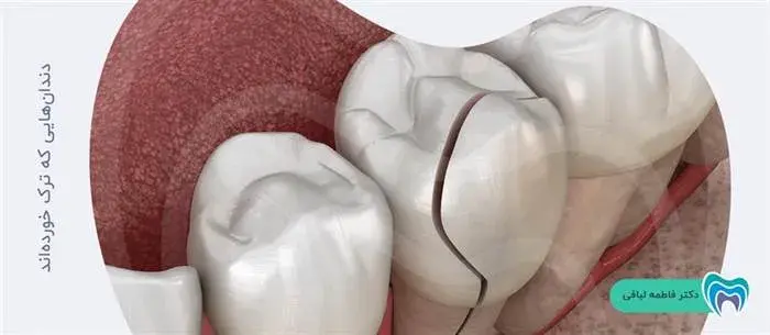 درمان دندانهای ترک خورده با لمینت سرامیکی