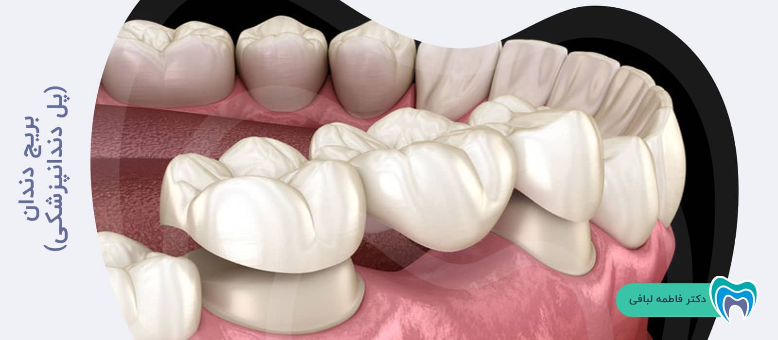 بریج دندان(پل دندانپزشکی)