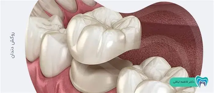 آیا از روکش برای از بین بردن لکه های دندان استفاده می شود؟