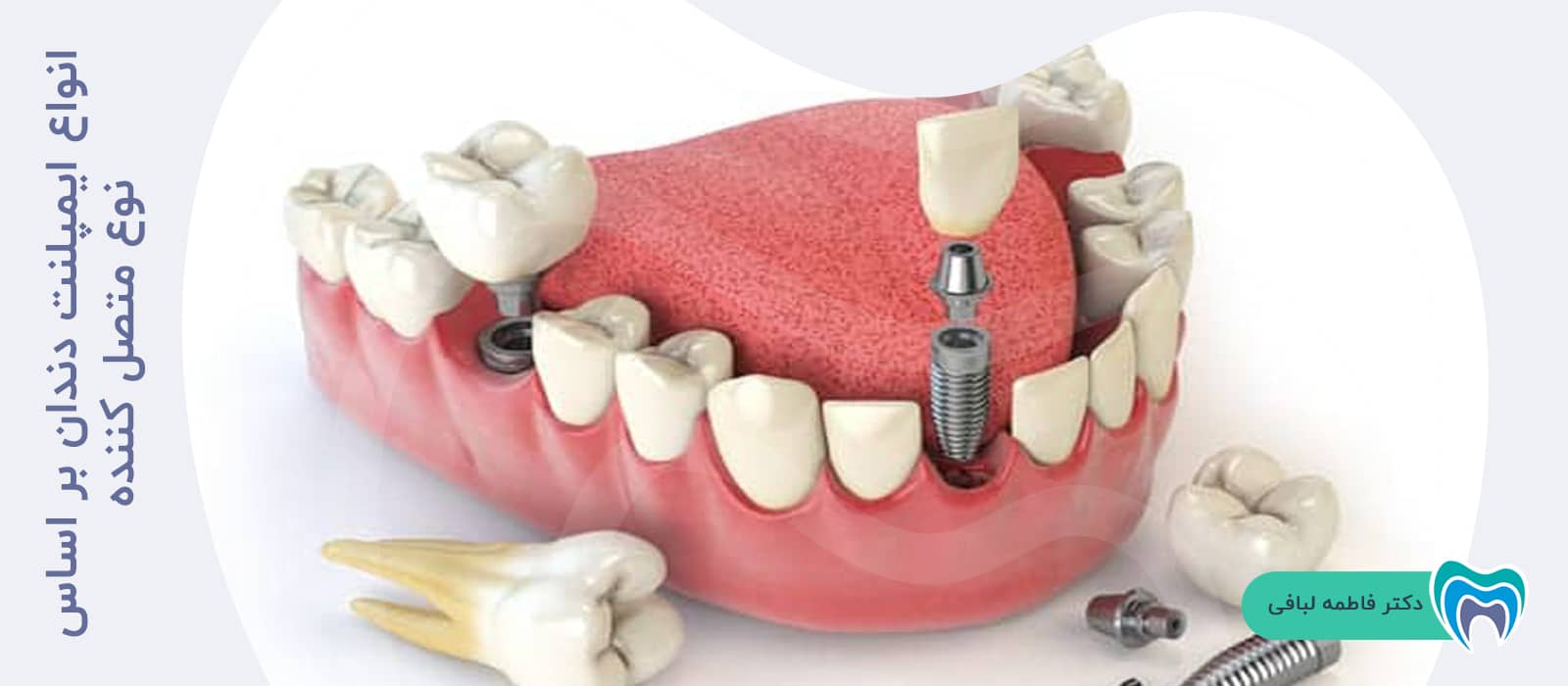 انواع ایمپلنت دندان بر اساس نوع متصل کننده