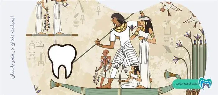 ایمپلنت دندان در مصر باستان