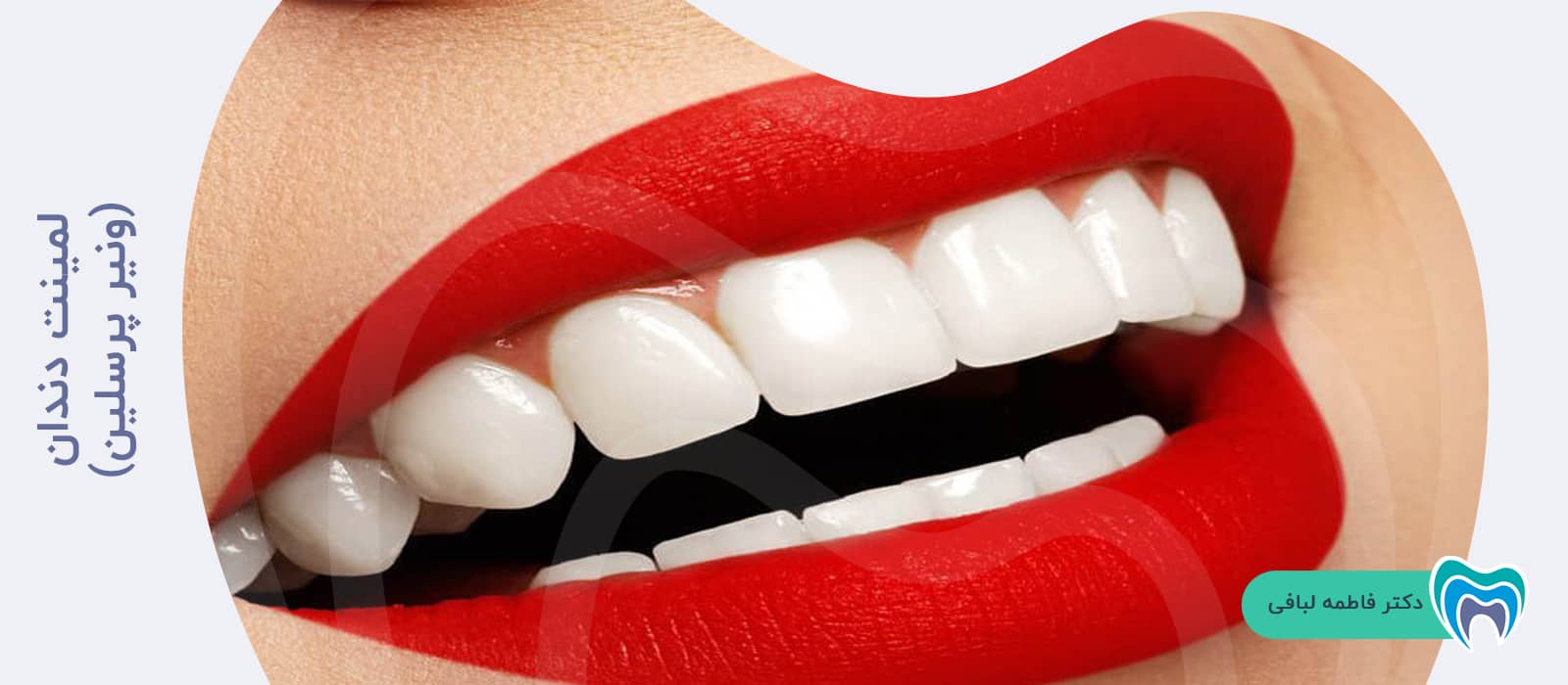 لمینت دندان برای سفید کردن دندان افراد سیگاری چه تاثیری دارد؟