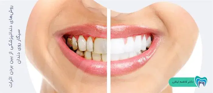 چگونه می‌توان اثرات سیگار روی دندان را درمان کرد؟