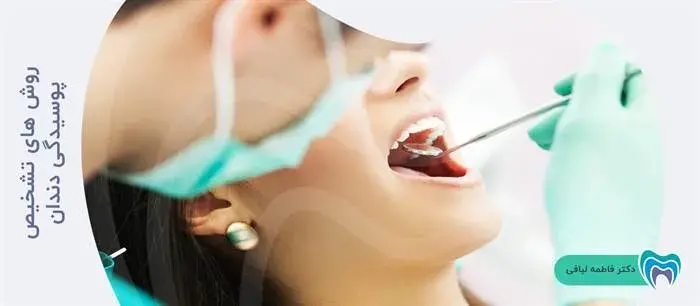 روش های تشخیص پوسیدگی دندان