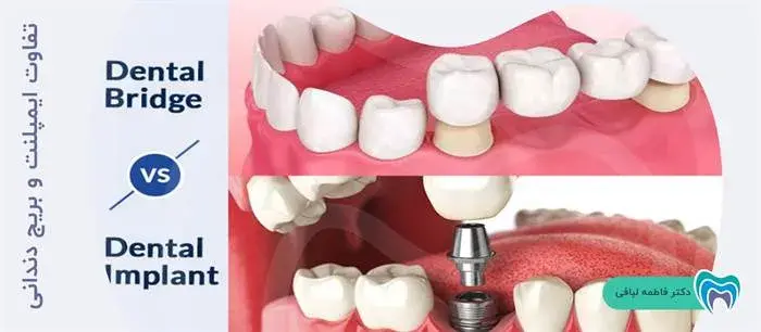 تفاوت ایمپلنت و بریج دندانی