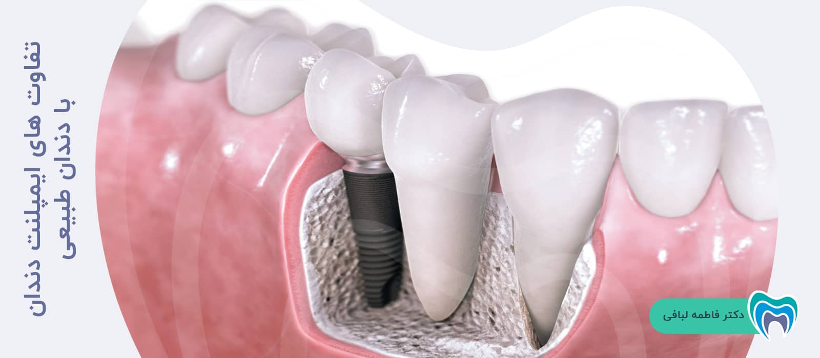تفاوت های ایمپلنت دندان با دندان طبیعی