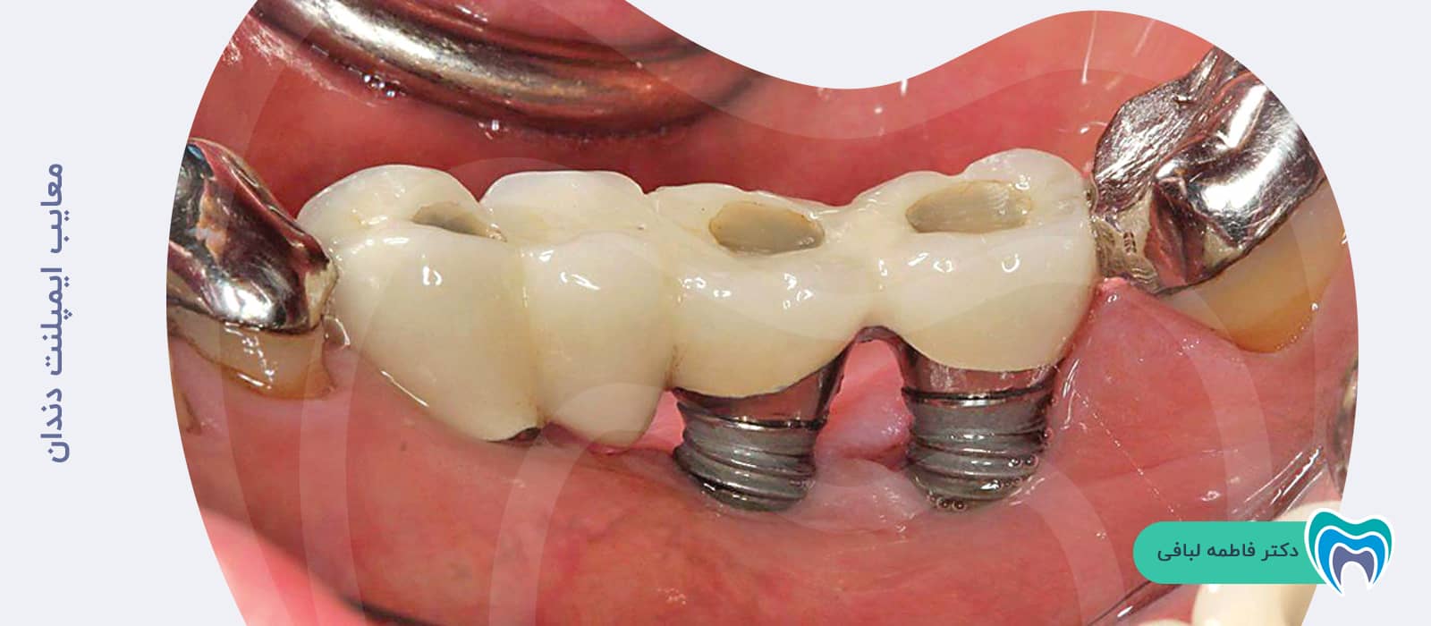  عوارض ایمپلنت دندان