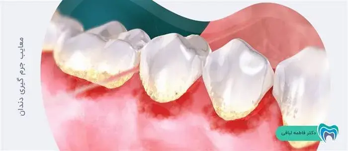 آیا جرم گیری دندان معایبی دارد؟