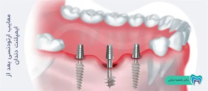 معایب ارتودنسی بعد از ایمپلنت دندان