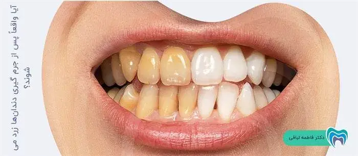 زرد شدن دندانها بعد از جرمگیری