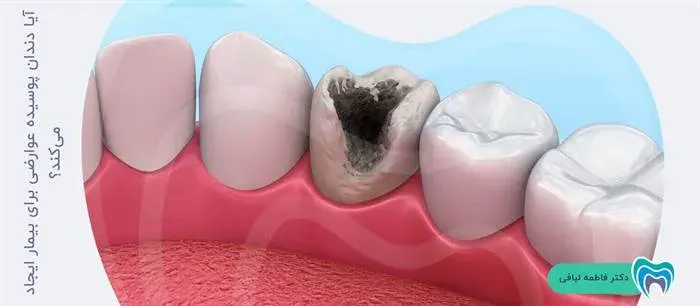 آیا پوسیدگی دندان باعث ایجاد عوارض میشود؟