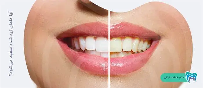 آیا دندان زرد شده سفید می‌شود؟