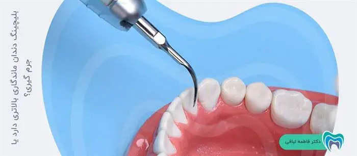 ماندگاری جرم گیری دندان بیشتر است یا بلیچینگ دندان؟