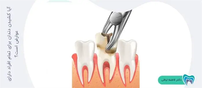 آیا همه کسانی که دندان خود را می‌کشند دچار عوارض پس از آن می‌شوند؟