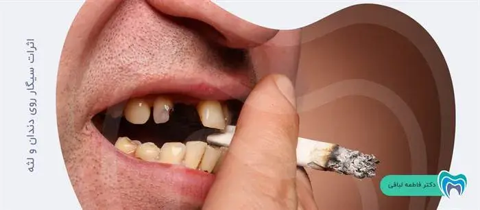 سیگار کشیدن چه تاثیری بر روی دندان‌ها دارد؟