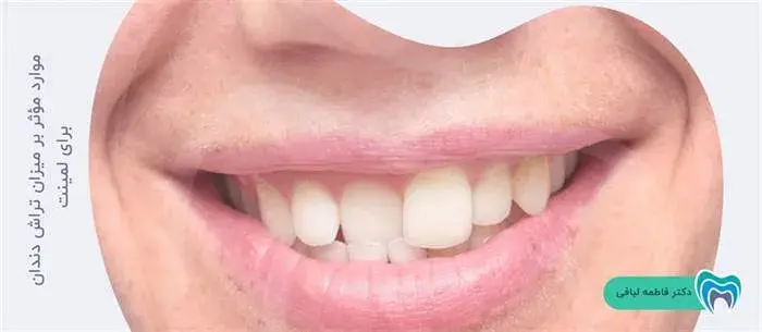 چه مواردی در میزان تراش دندان برای لمینت تاثیر دارند؟