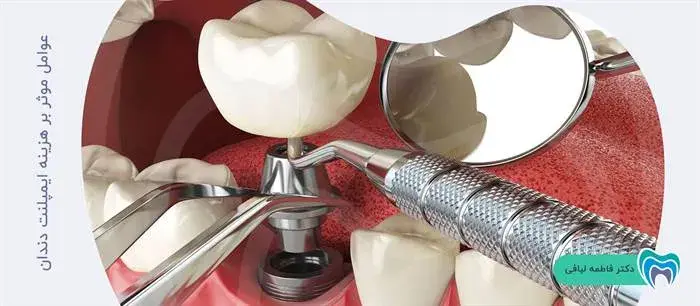 عواملی که بر قیمت ایمپلنت دندان تاثیر می‌گذارند